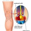 Varicose Vein Issues and Diabetes