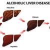 What Does Liver Disease Have to do With Diabetes?