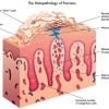 Psoriasis & Diabetes - The Most Current Information