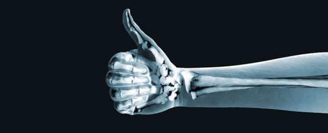 X-Ray of a thumbs up