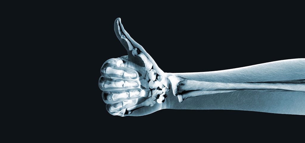 X-Ray of a thumbs up