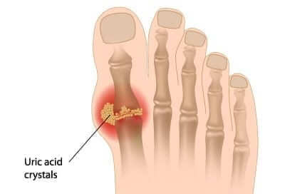 Gout and Diabetes