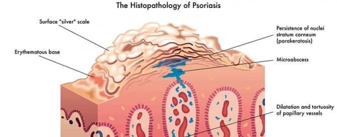 The Histopathology of Psoriasis - Featured Image
